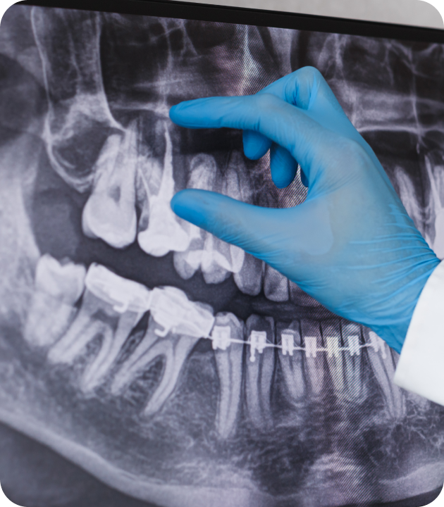 retraitement endodontique villeneuve d ascq Retraitement endodontique Cabinet d’Endodontie Lillois