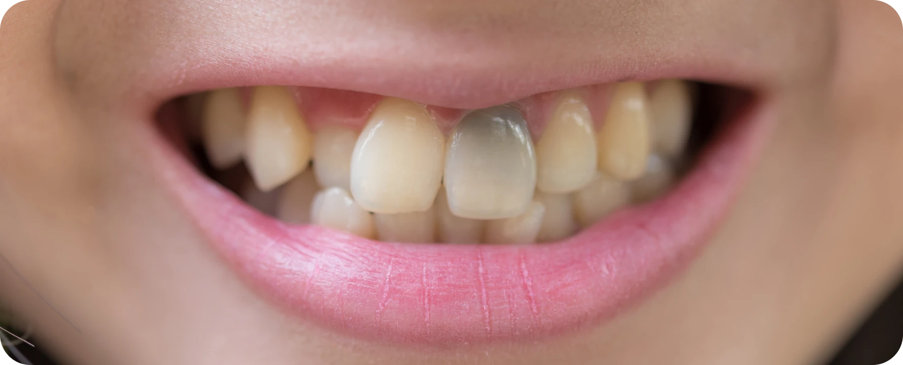 anatomie complexe microscope operatoire Éclaircissement interne Cabinet d’Endodontie Lillois