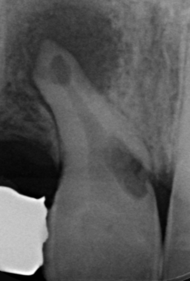 endodontie villeneuve ascq confort Résorption Cabinet d’Endodontie Lillois