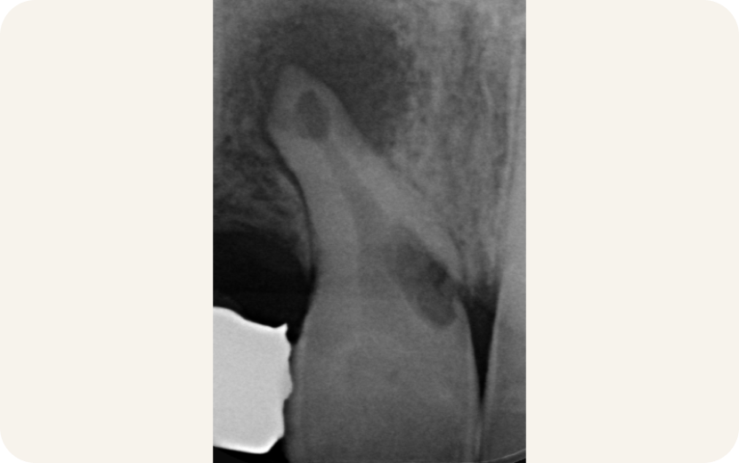 resorption endodontie villeneuve d ascq Résorption Cabinet d’Endodontie Lillois