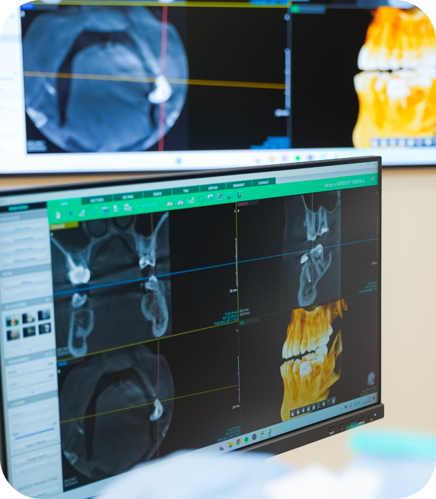 traitement endodontique anatomie complexe villeneuve d ascq Traitement endodontique : anatomie complexe Cabinet d’Endodontie Lillois